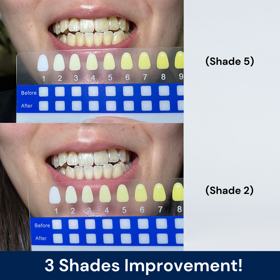 BLU Teeth Whitening Kit