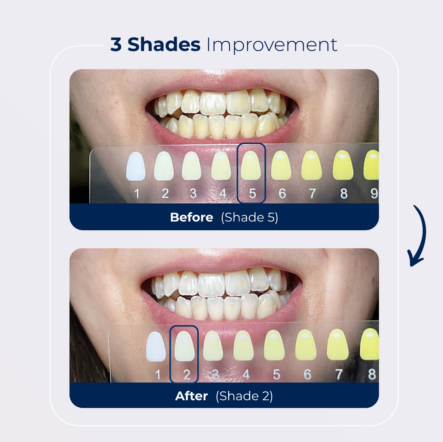 BLU Teeth Whitening Kit