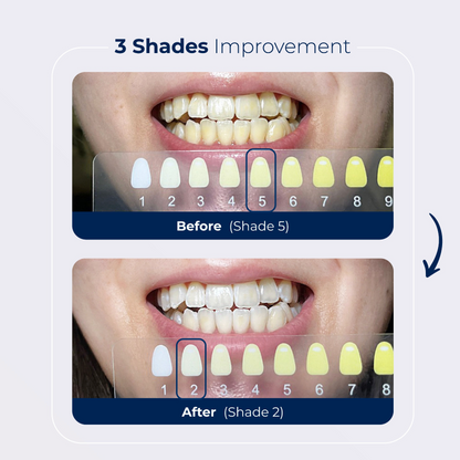 BLU Teeth Whitening Kit